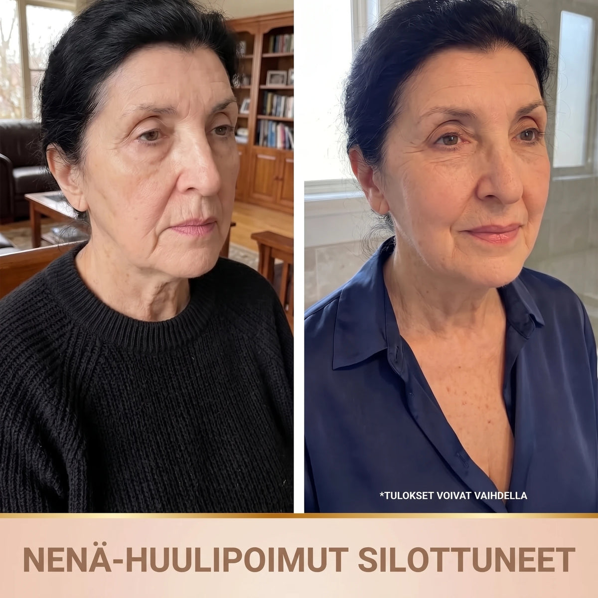 Ennen ja jälkeen: nenä-huulipoimut silottuneet