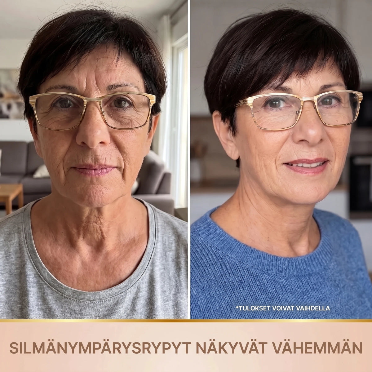 Ennen ja jälkeen: silmänympärysrypyt näkyvät vähemmän